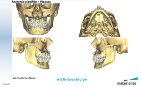 chirurgie-orthognathique